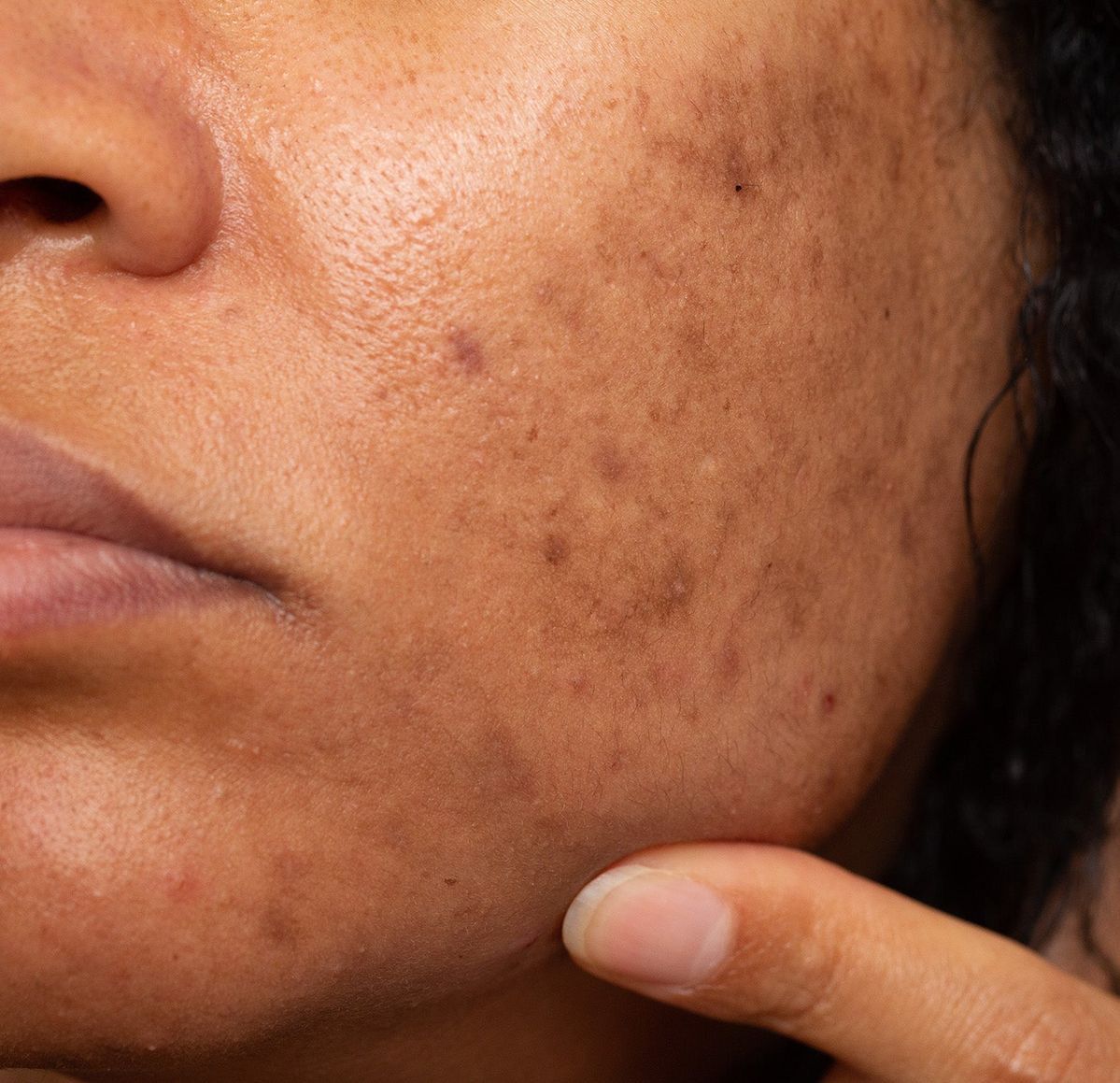 Illustrative visual on melanin-rich skin hyperpigmentation